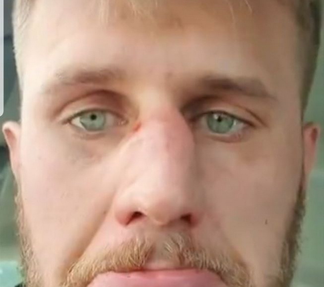 Brzeski złamany nos 